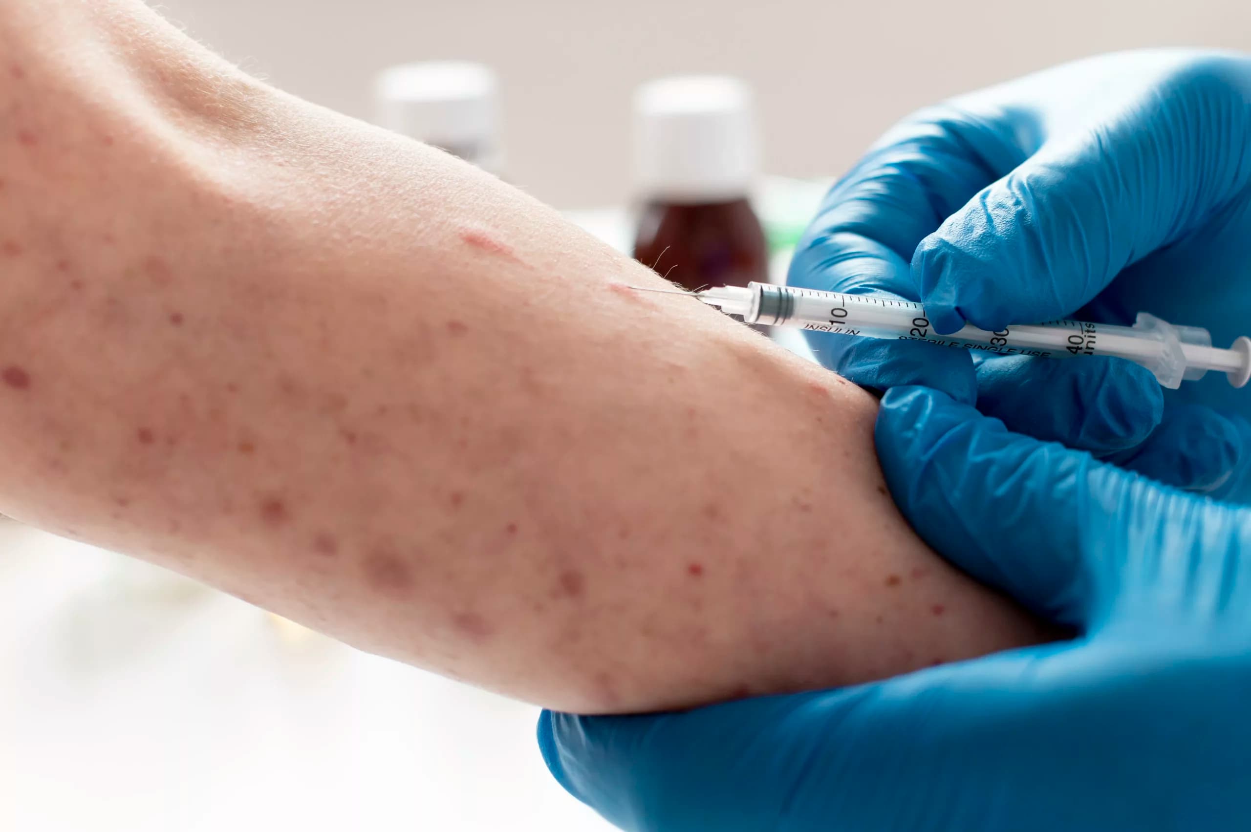 Com 709 casos de mpox no Brasil, ministério convoca reunião