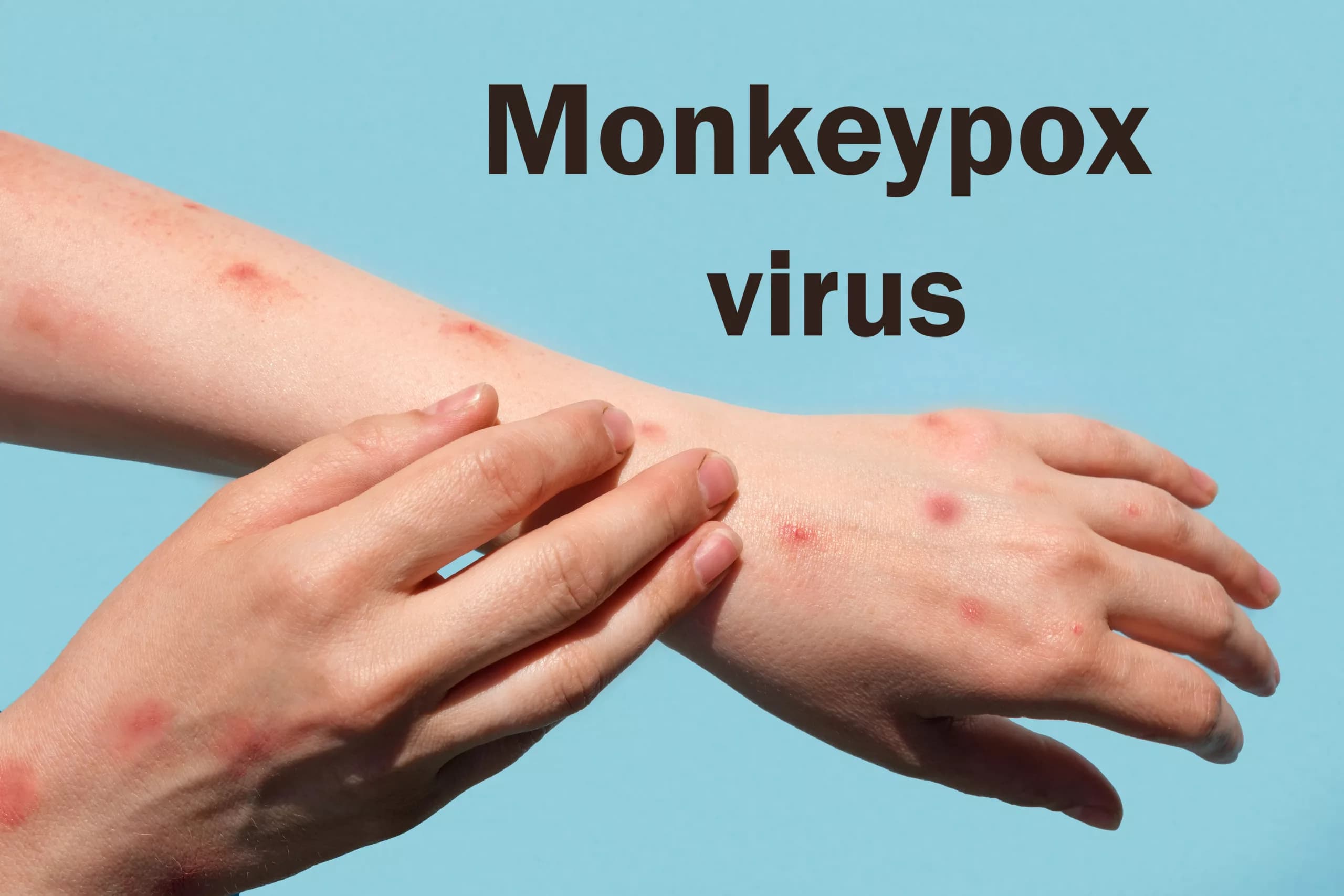 Mpox: OMS volta a declarar emergência em saúde pública global