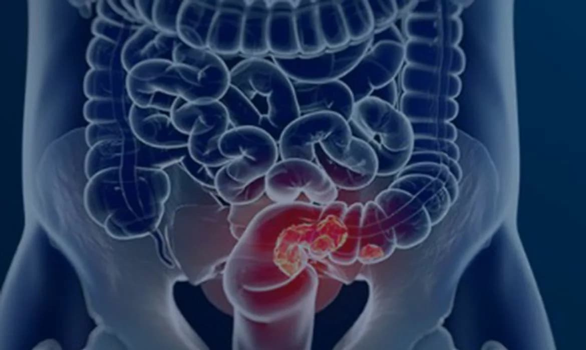 Câncer de intestino: mortes podem aumentar 36% até 2040 por atraso no diagnóstico