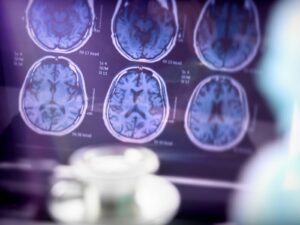 Diagnóstico precoce de alzheimer: Como reconhecer sinais e melhorar a qualidade de vida